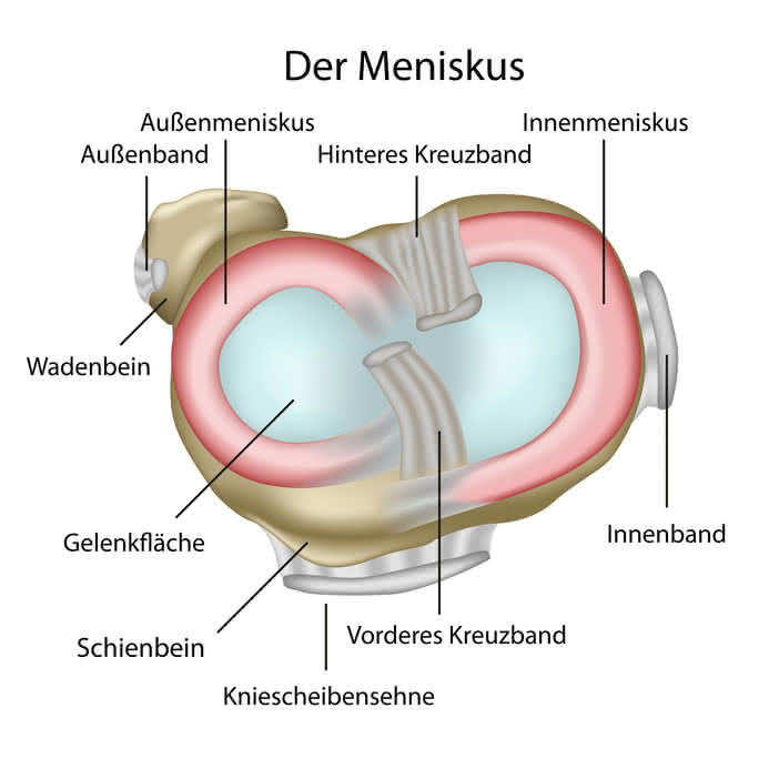 Meniskusschaden